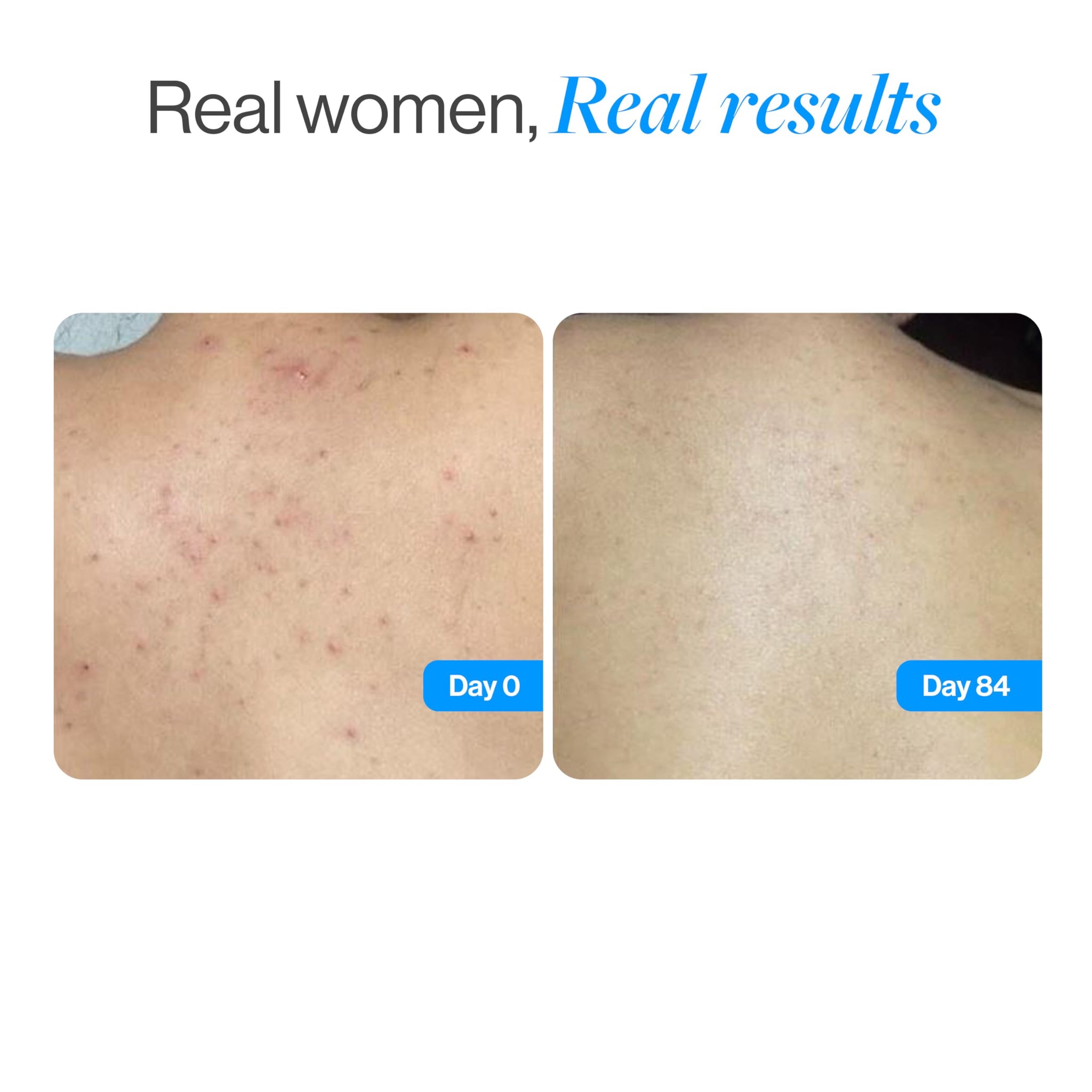 Be Bodywise Salicylic Acid Exfoliating Body Wash Gel for All Skin Types - label detail (37)