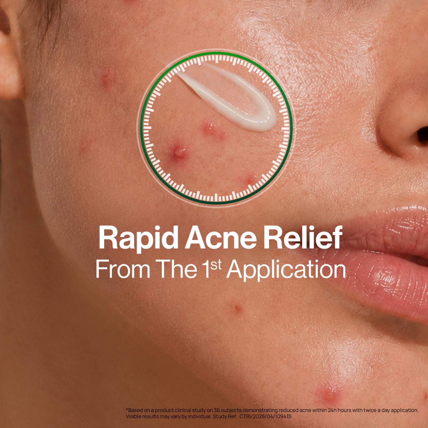 OZiva Acne Spot Corrector Gel, 5% Green Tea Extract, 1% Willow Bark, 20g - front view