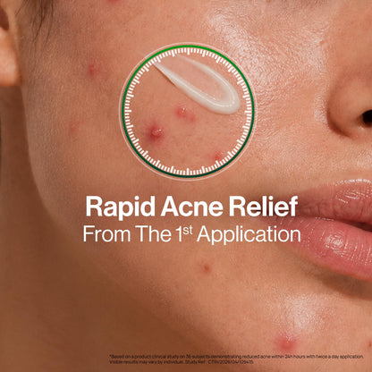 OZiva Acne Spot Corrector Gel, 5% Green Tea Extract, 1% Willow Bark, 20g - front view