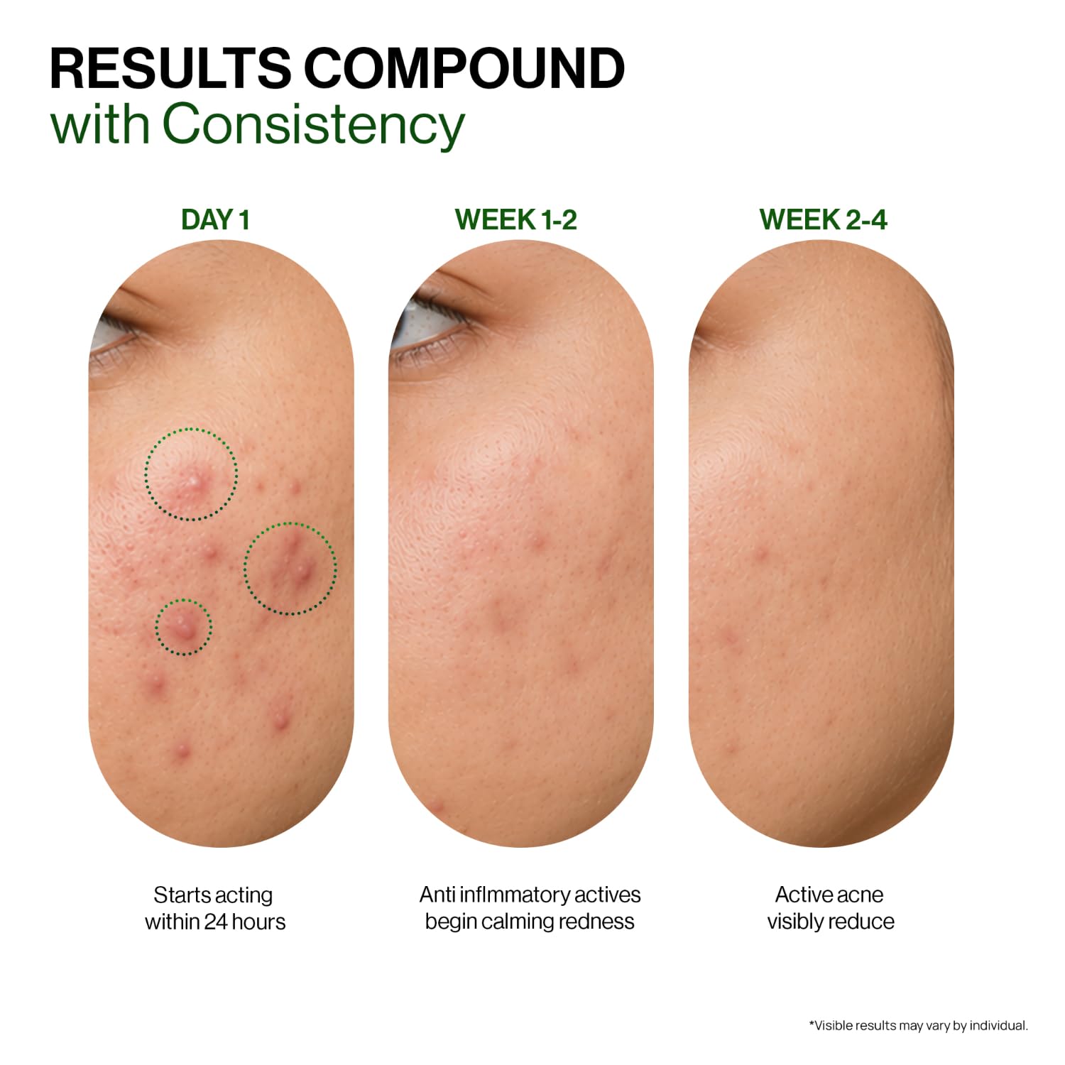 OZiva Acne Spot Corrector Gel, 5% Green Tea Extract, 1% Willow Bark, 20g - close-up detail
