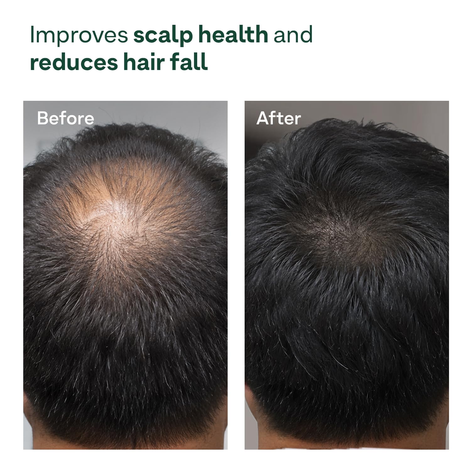 OZiva Hair Growth Serum for Scalp with Redensyl and Lindera Root Extract - packaging